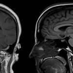 Łagodna infekcja Covid może prowadzić do „ważnych” zmian w mózgu
